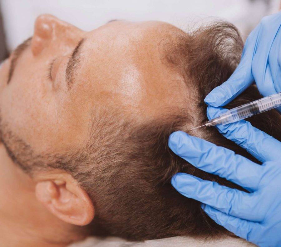 Close up of a mature man receiving hairloss treatment injections in scalp by professional trichologist. Dermatologist doing scalp injections for mature male client with alopecia problem